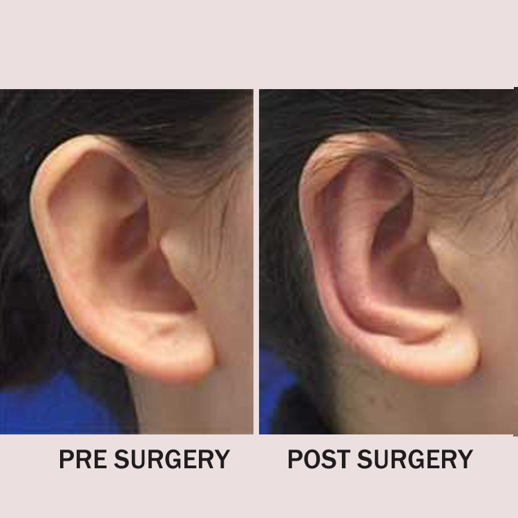 Ear Pinning Surgeon in Manchester